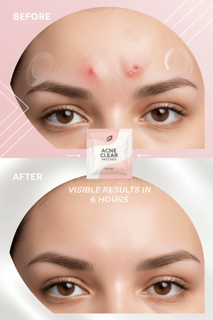 Invisible Pimple Patches